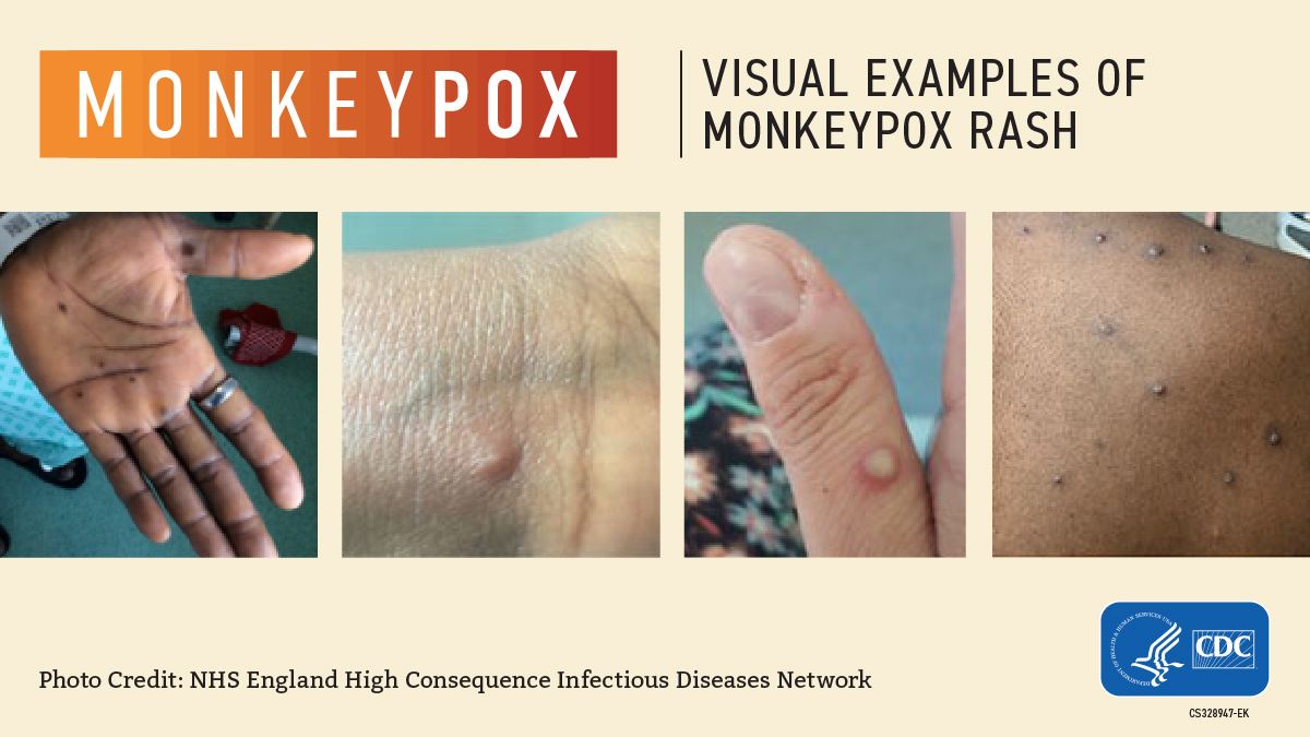 Who declares rapidly spreading monkeypox outbreak a global health emergency