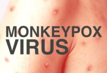 Monkeypox symptoms outbreak